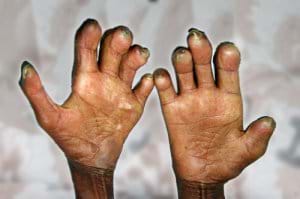 Leprosy Cases In Wa On The Increase
