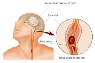 Stroke  Indicator